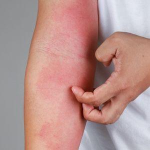 Eczema on Arm - Can an Infrared Sauna Help?