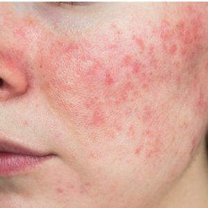 Rosacea Skin Condition on Face that may Be helped with Infrared Sauna Sue
